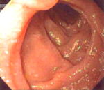 Normal Duodenum